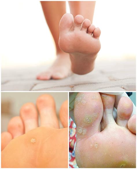 Plantar Wart Home Remedy: 11 Treatments. Easy Home Remedies for Wart Removal