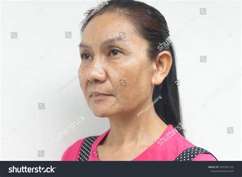Blemishes And Freckles Face: Over 2,181 Royalty-Free Licensable Stock Photos | Shutterstock