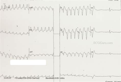 Wide-Complex Tachycardia Converted by Adenosine | ECG Guru - Instructor Resources