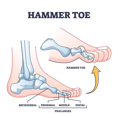 What Causes Hammer Toe? – The Healing Sole