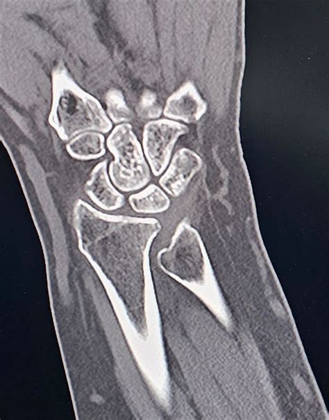 Ulnar impingement syndrome: early radiographic signs and distinction from ulnar impaction ...