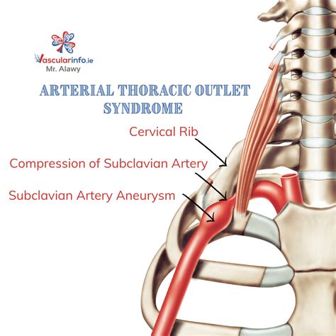 Thoracic Outlet Syndrome - Vascular Info