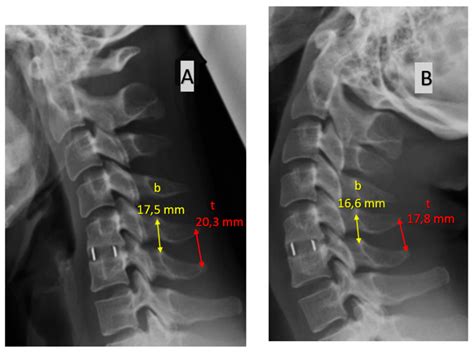 Reliability and Utility of Various Methods for Evaluation of Bone Union after Anterior Cervical ...
