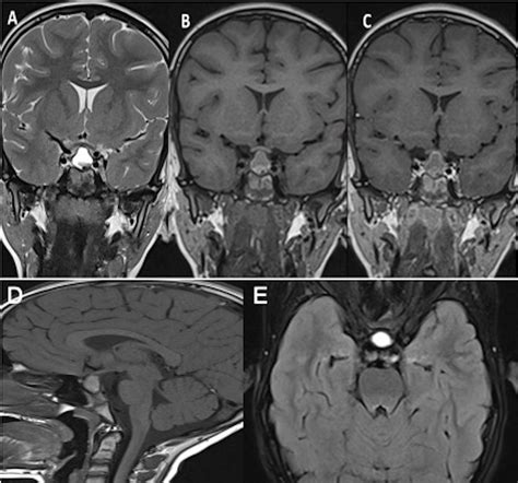 Different Faces of Rathke’s Cleft Cyst | Journal of the Belgian Society ...