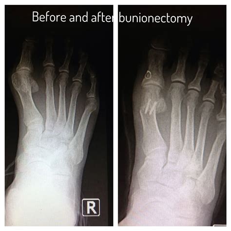 Bunion X-Rays | Advanced Podiatry - Advanced Podiatry of Manhasset, Huntington, Coram, Woodbury ...