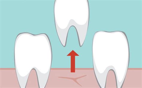 Image result for Stitches After Tooth Extraction