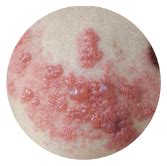 Penvir - Famciclovir, Antiviral Medicine for Shingles and Genital Herpes