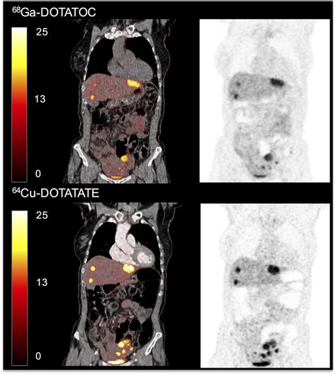 Head-to-Head Comparison of 64Cu-DOTATATE and 68Ga-DOTATOC PET/CT: A Prospective Study of 59 ...