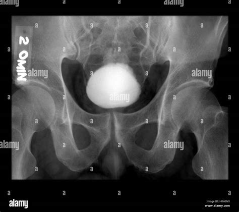 For bladder Black and White Stock Photos & Images - Alamy