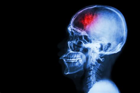 What is CTE Disease? A Comprehensive Guide
