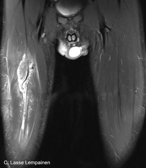 Rectus femoris injury information - Urheiluortopedi Lasse Lempainen