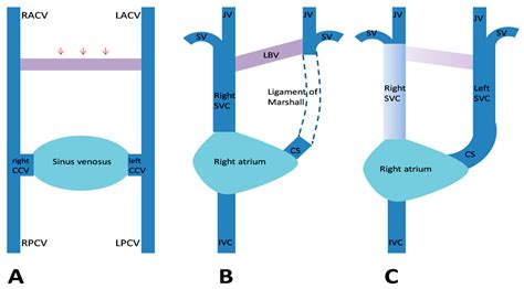 Persistent Left Superior Vena Cava with Absent Right Superior Vena Cava and Discrete Subaortic ...