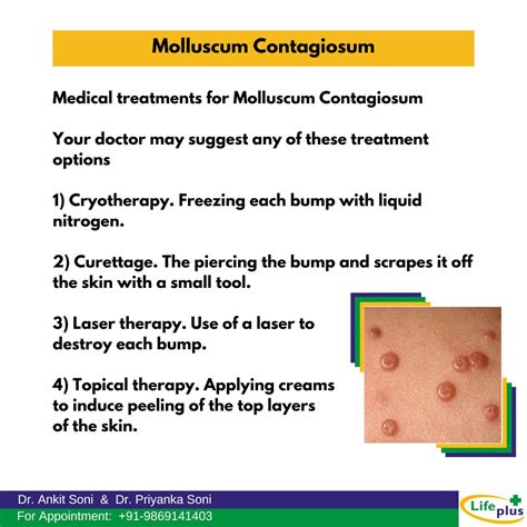 Medical treatments for Molluscum Contagiosum | Dr. Ankit Soni posted on the topic | LinkedIn