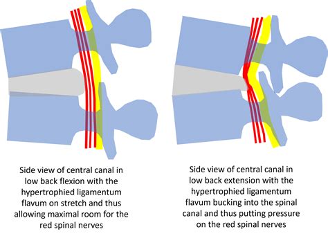 What is the Ligamentum Flavum? Why Should You Care? - Regenexx