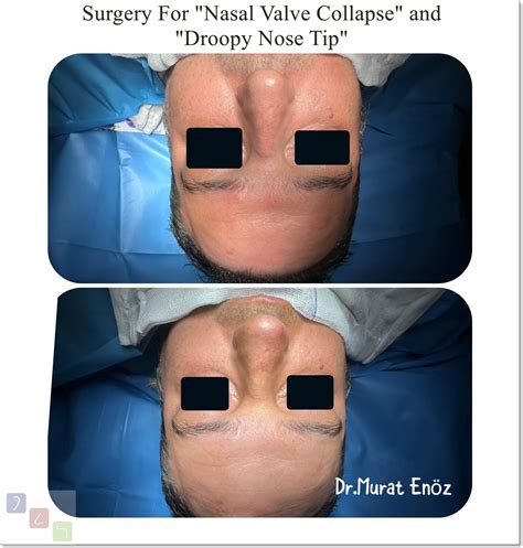 Nasal Valve Collapse and Treatment