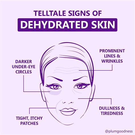 Flushed Face Dehydration at Christy Calvin blog