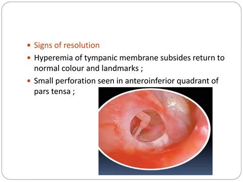 Acute suppurative otitis media | PPTX