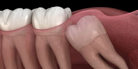Why do Wisdom Teeth Need to be Removed? - Top Rated Cosmetic & General ...
