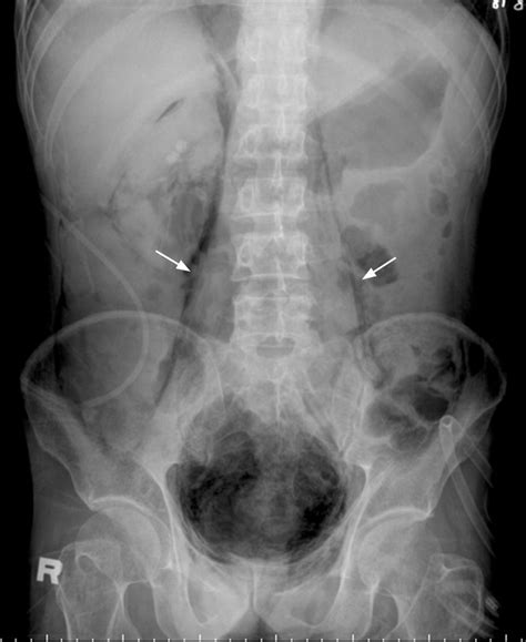 Outlined psoas muscle shadow | Emergency Medicine Journal