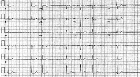 Digitalis Toxicity Ecg at Cyril Sandy blog