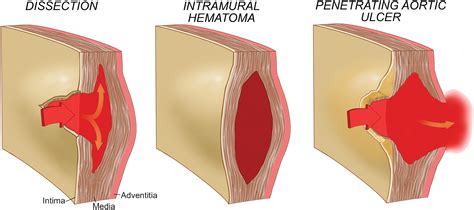 Timing of Intervention for Aortic Intramural Hematoma - Annals of Vascular Surgery