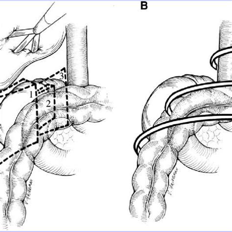 Image result for Nephrectomy Positioning