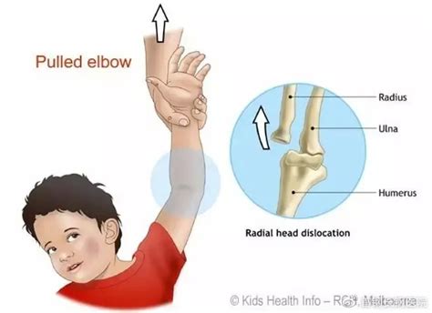 家长注意：儿童防脱臼，这几个动作千万别再做了|肘关节|脱臼|儿童|动作|家长|脱位|-健康界