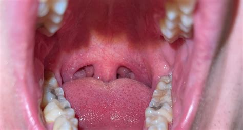 Are my tonsils larger than average? : r/snoring
