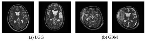 Brain Tumor Class Detection in Flair/T2 Modality MRI Slices Using ...