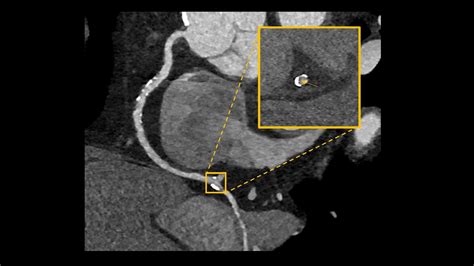 Beneath the calcified plaque in the distal right coronary artery - Siemens Healthineers