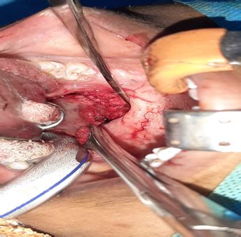 An unusual case of lymphoepithelial cyst of palatine tonsil - J ...
