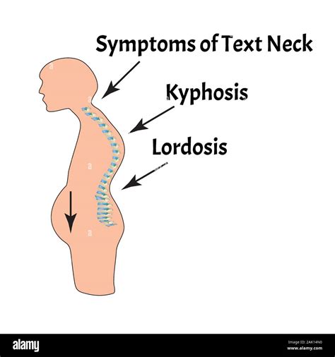 Lordosis Kyphosis