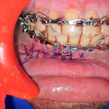 18-Year-Old with Parasymphysis Unilateral Mandibular Fracture Treated ...