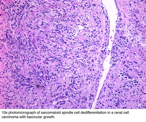Spindle Cell Tumor Pathology Outlines at Sarah Bugarin blog