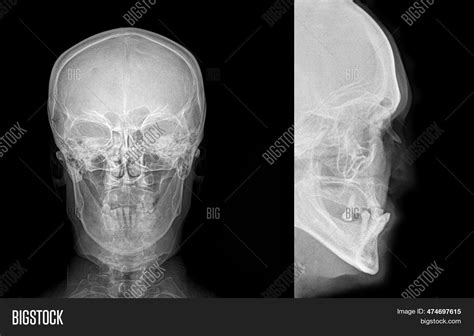 Nasal Bone Anatomy X Ray Normal Nasal Bone X Ray Gallery