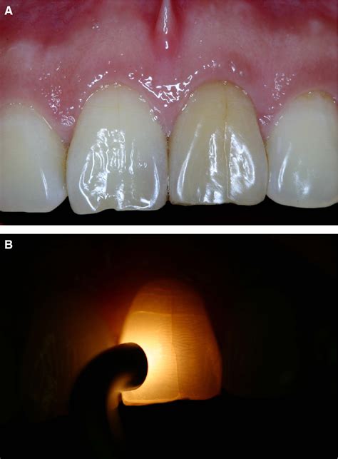 Tooth Hairline Fracture