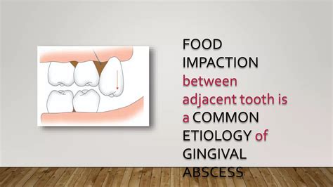 Abscess of periodontium | PPTX
