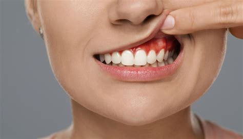 Understanding and Treatment Methods for Gum Diseases - Dental Healty