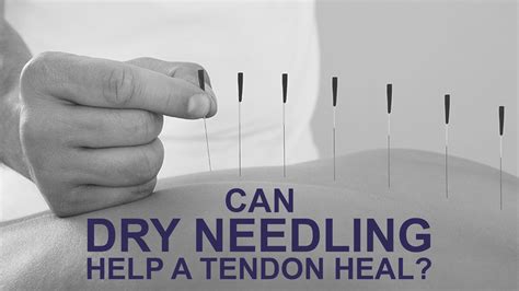 Dry Needling Treatment For Achilles Tendonitis at Tiffany Mora blog