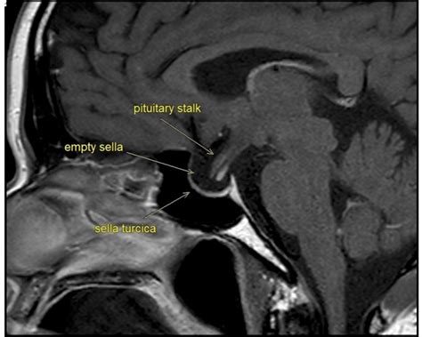 Management Of Empty Sella Syndrome - Infoupdate.org