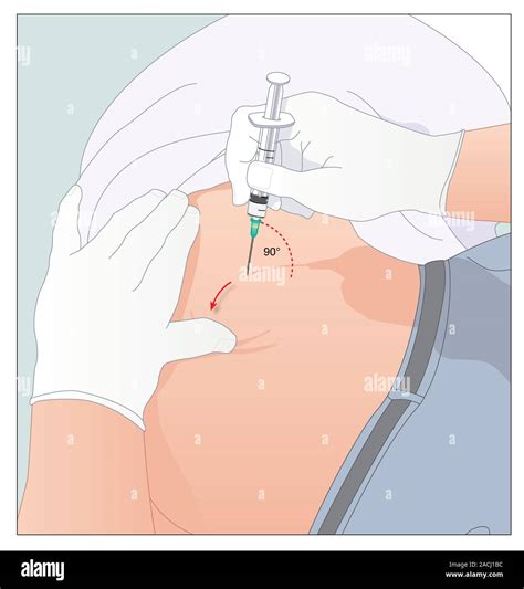Intramuscular dorsogluteal injection. Artwork showing the correct site ...