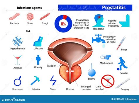 Prostatitis. Benign Enlargement Of The Prostate Stock Vector - Image: 62495676