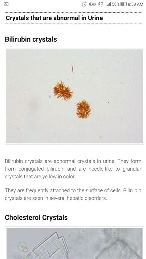 Bilirubin Crystal In Urine