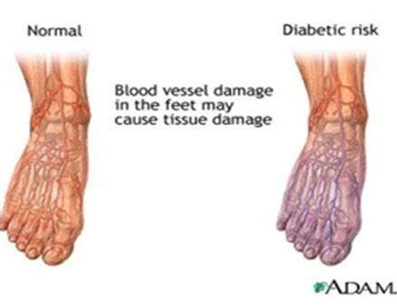 #1 Foot Care for Diabetic Feet - Comfort & Protection | KARE