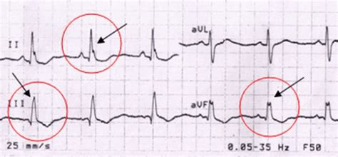 Image result for ASD Extension