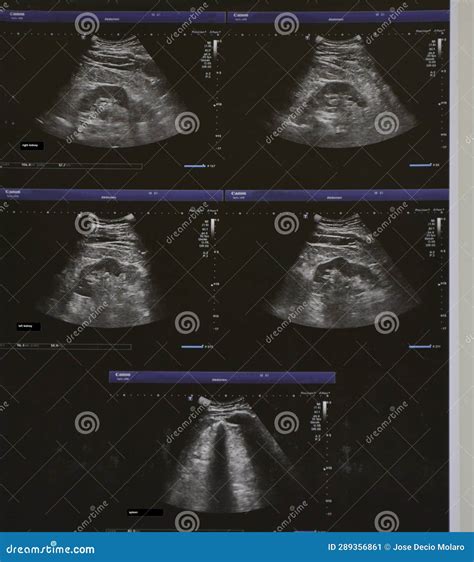 Ecografía De La Parte Superior Del Abdomen O Del Riñón Ultrasonido Que ...