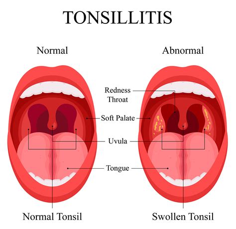 Tonsillitis: Pathophysiological Changes in Oropharyngeal Anatomy - Anatomy Note
