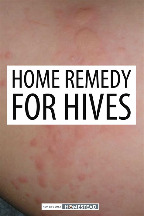 Home Remedies For Hives