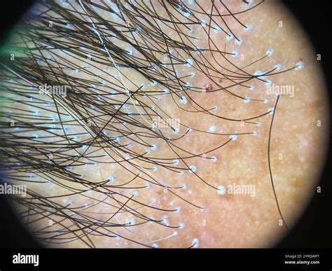 Dermatoscope image of frontal fibrosing alopecia affecting a 68 year old patient. This is a form ...