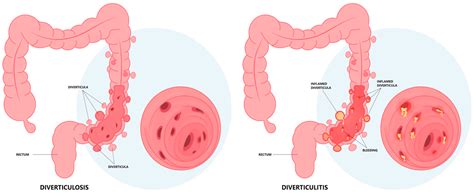 Y Diverticulitis Des Divertículos | Diverticulitis Y Cáncer De